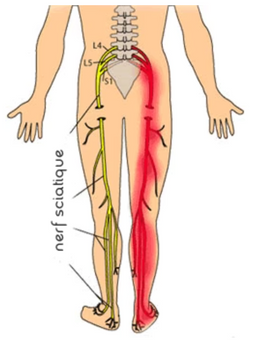 nerf sciatique