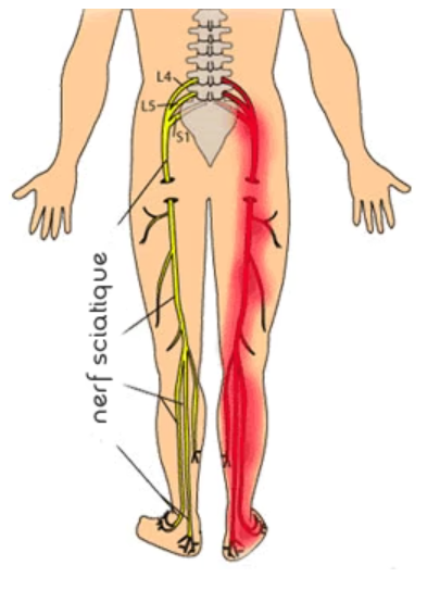 nerf sciatique